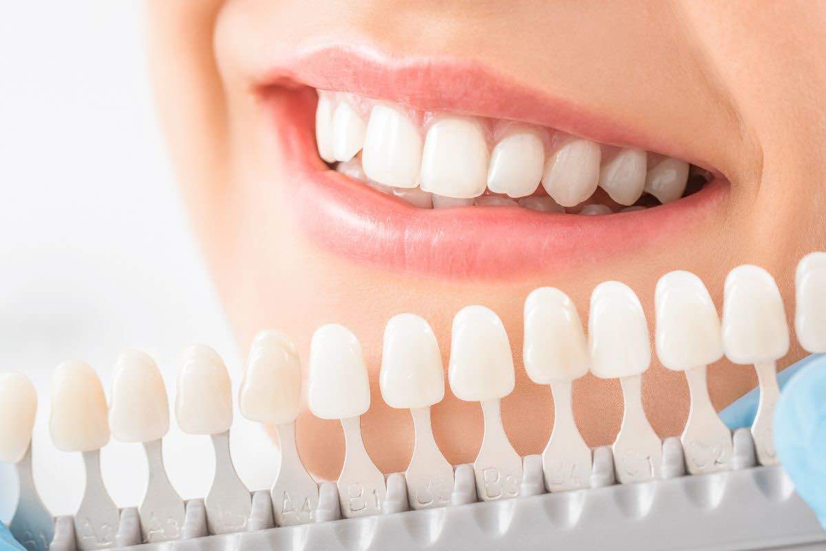 Denti bianchi